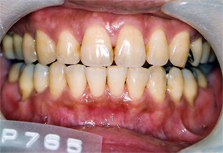 whitening1