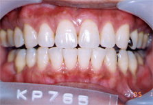 whitening2